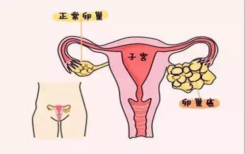 卵巢癌的症状有哪些