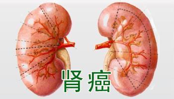 肾癌的症状是什么