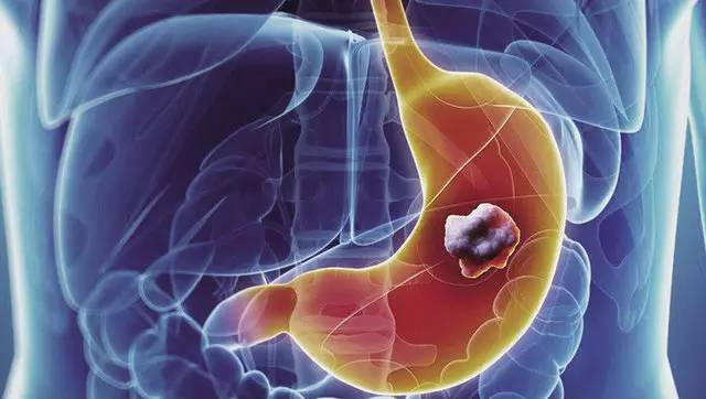 胃癌晚期的常见症状有哪些？出现这些症状小心是晚期