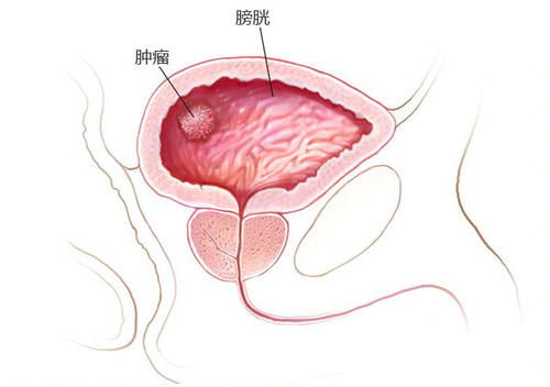 膀胱癌早期有哪些症状表现？